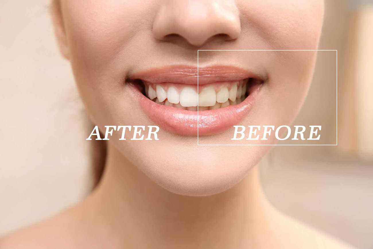 What Are the Most Effective Natural Teeth Whitening Methods You Can Try Reigate?