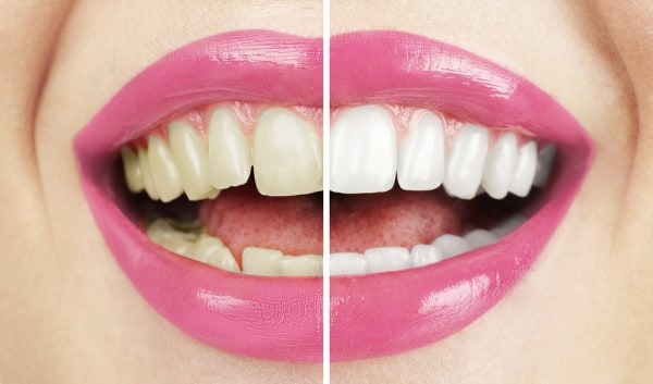 What Early Signs of Oral Cancer Should You Never Ignore Reigate?