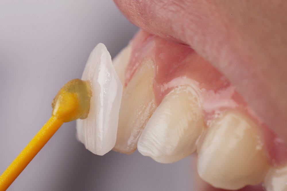 Why Do Dental Crowns Fail or Get Damaged Prematurely Reigate?