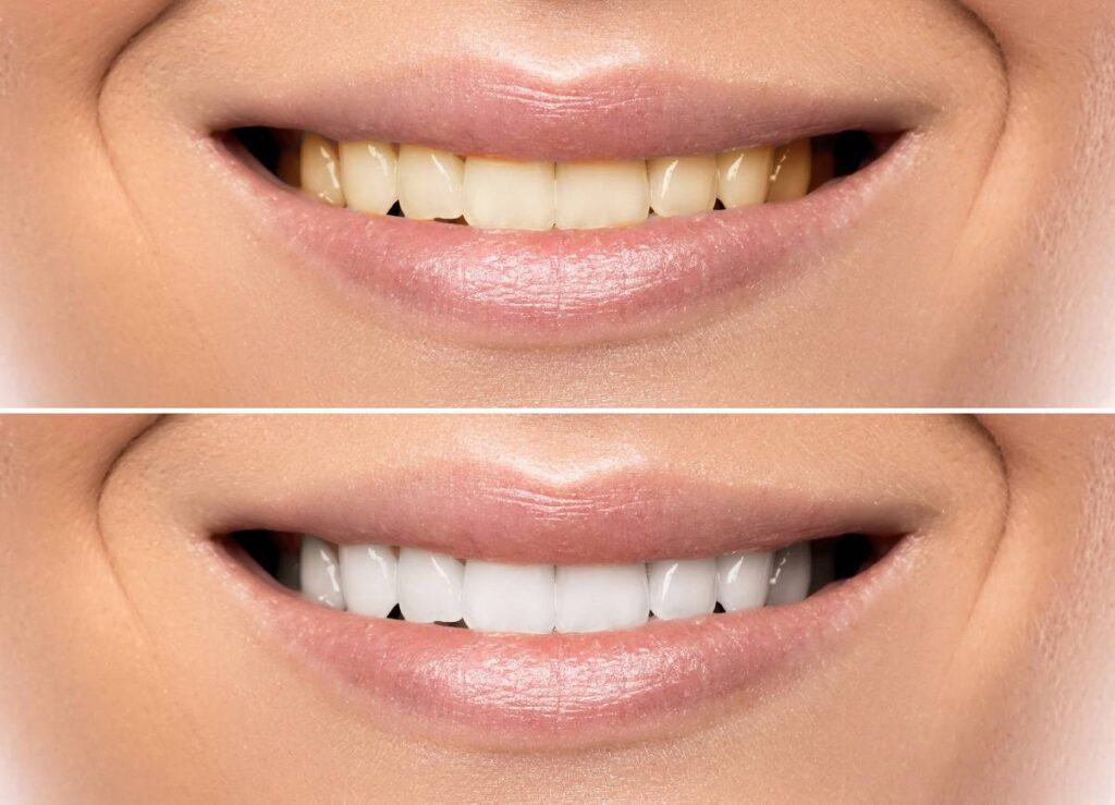 How Does Gum Disease Progress if Left Untreated Reigate?