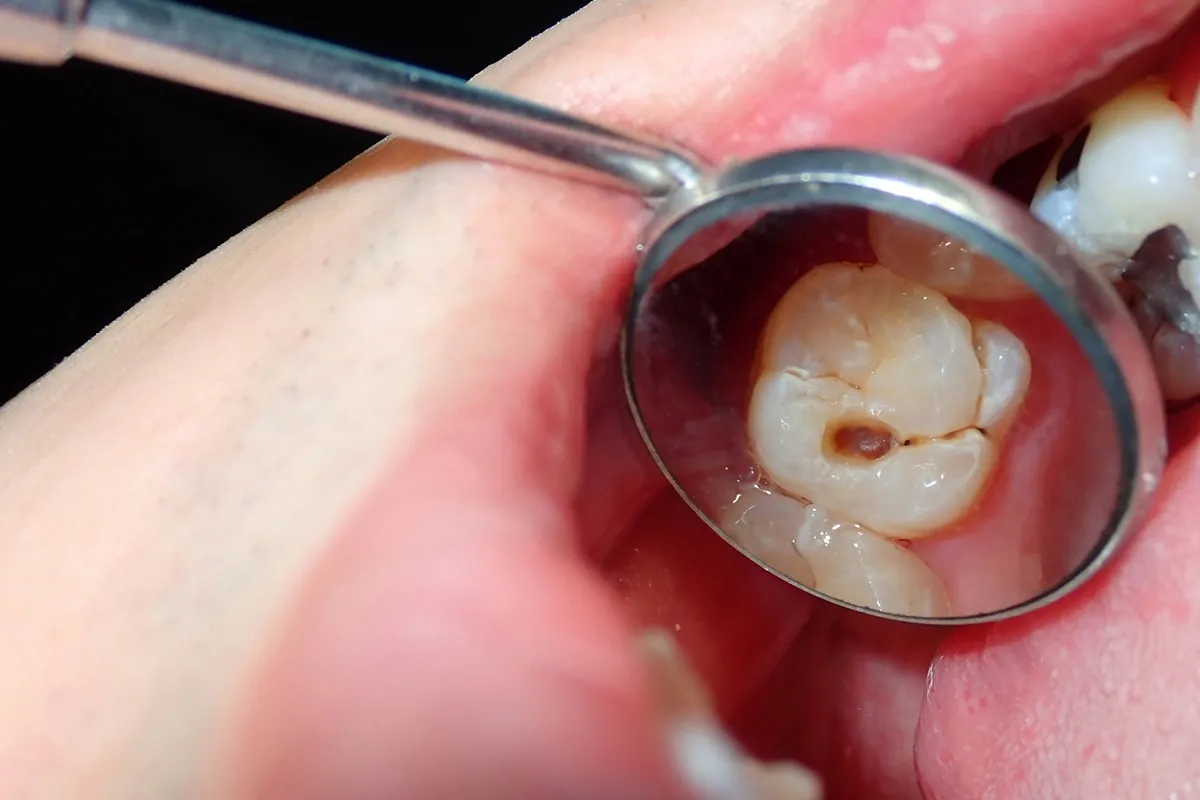 Why Do Teeth Crack? Common Causes to Know Reigate