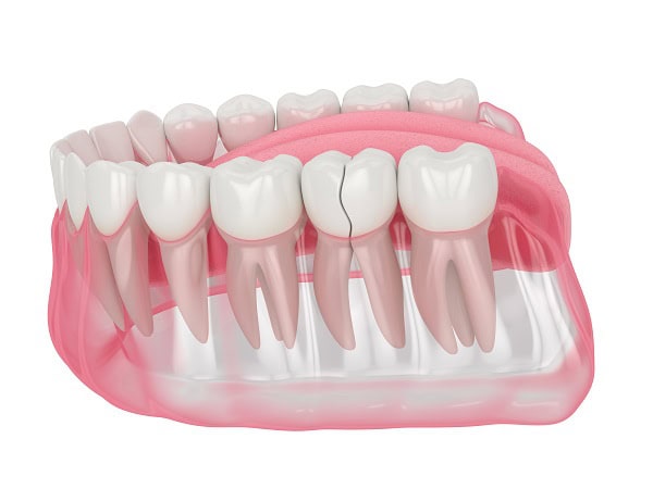 How Can You Manage Pain and Discomfort After a Root Canal Reigate?