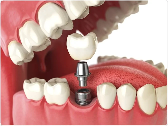 How Do I Decide Which Tooth Replacement Is Right for Me Reigate?