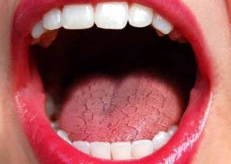 Common Causes of Dry Mouth (Xerostomia) Reigate