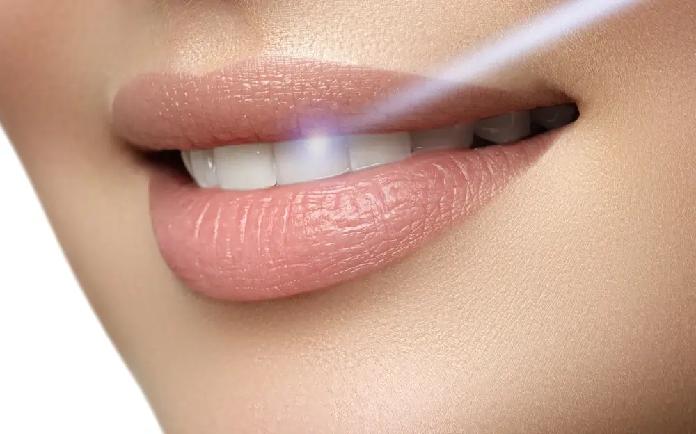 Is Laser Teeth Whitening Safe for Your Teeth and Gums Reigate?