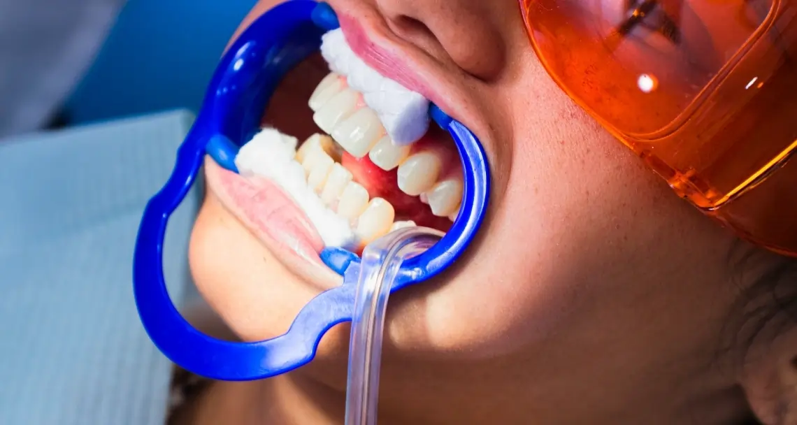 Why At-Home Laser Teeth Whitening Is Faster Reigate