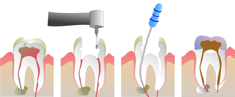 How Do You Properly Care for Your Teeth After a Root Canal Reigate