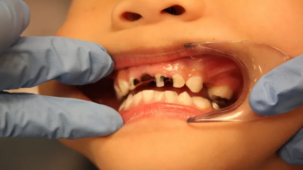 Which Foods and Drinks Cause the Most Damage to Young Smiles Reigate?
