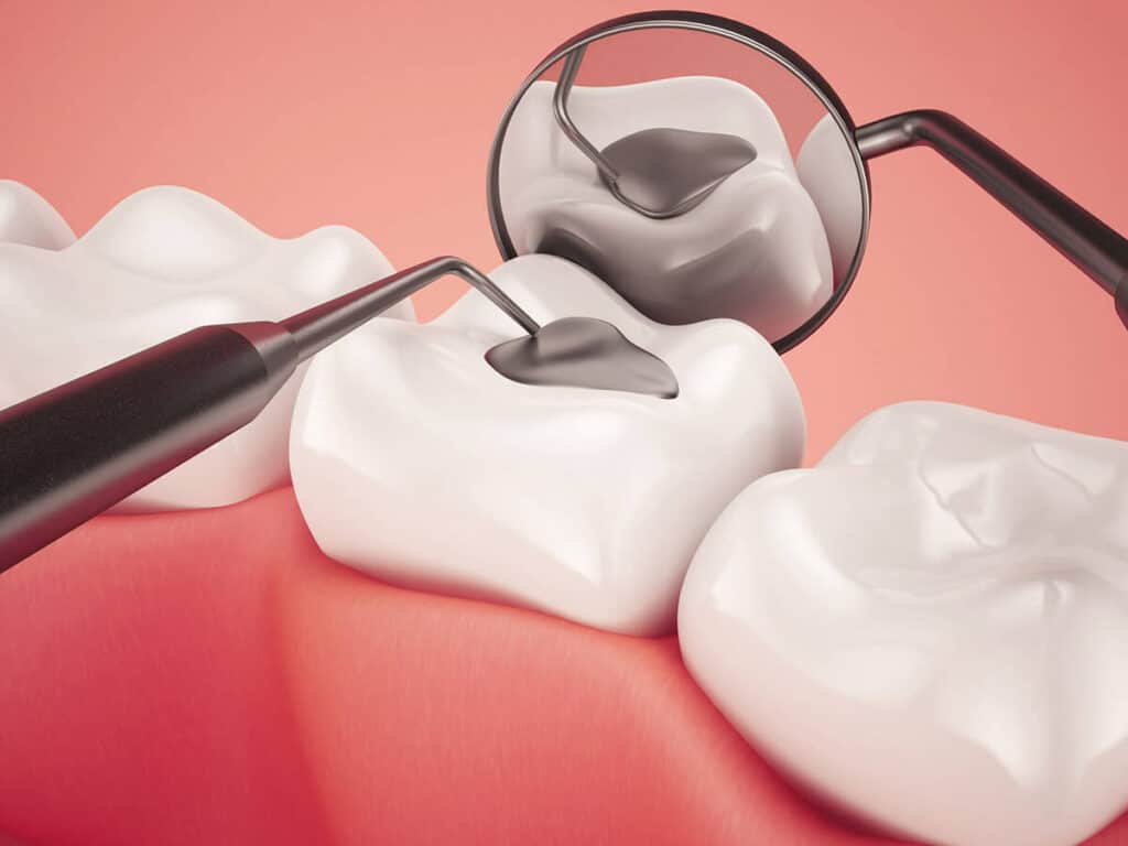 How Can You Prevent Tooth Decay Effectively Reigate