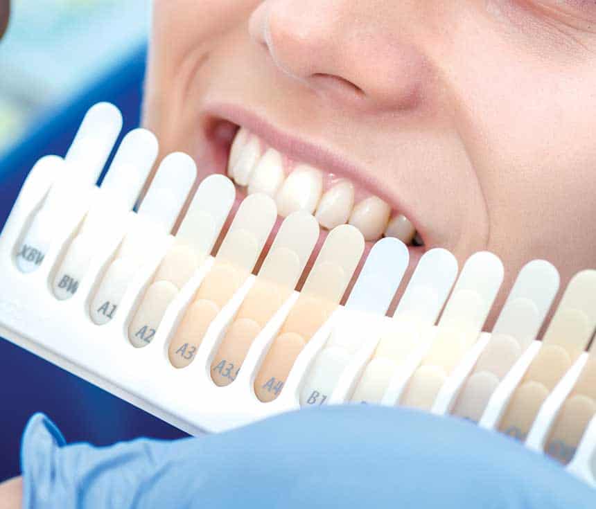 Professional vs At-Home Whitening: What You Need to Know Reigate