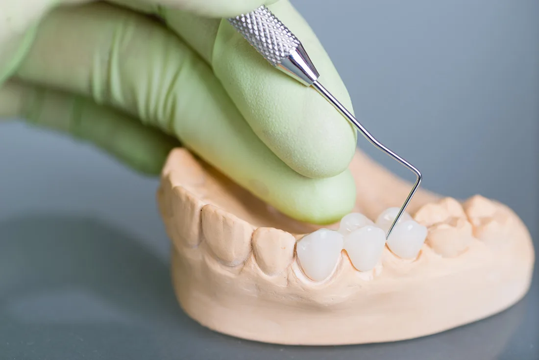What Are the Different Types of Dental Crowns Available Reigate?