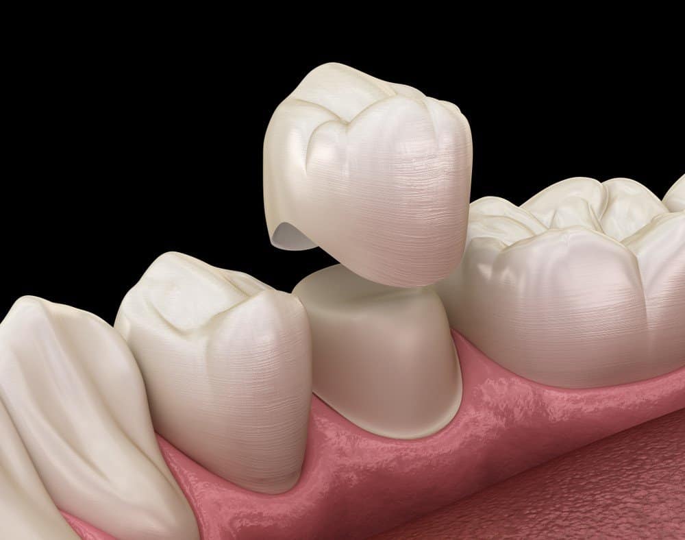 What Daily Habits Help Protect Your Dental Crowns Reigate?