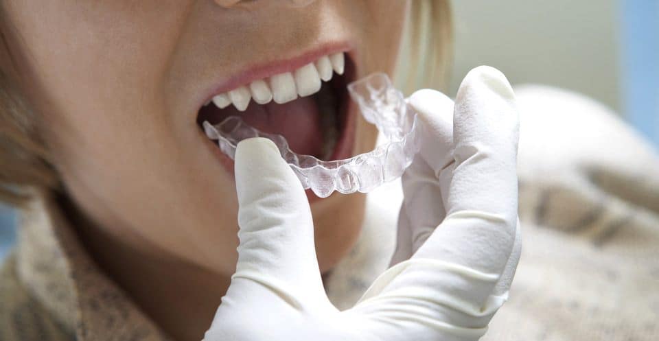 Why Bleaching Trays Require More Time Reigate
